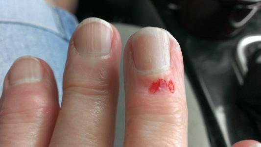 Skin glue didn't work on finger laceration; PA decided to stitch up 60  hours later. Is this ok? : r/woundcare