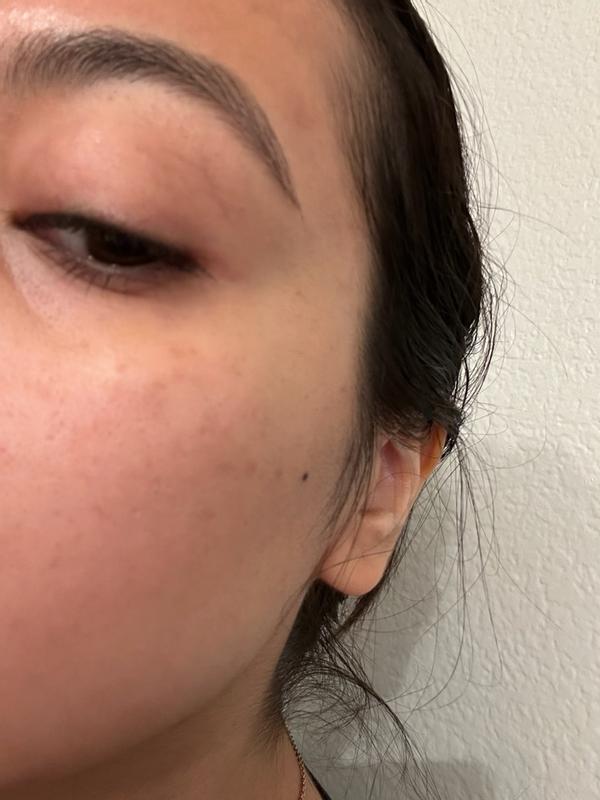 Customer photo for "Holy grail staple for clear skin!"