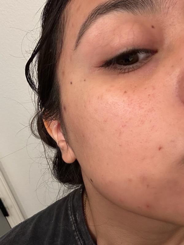 Customer photo for "Holy grail staple for clear skin!"