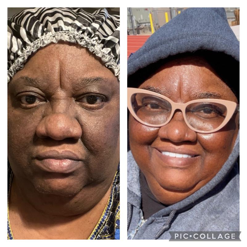 Pic #1 before and after no makeup. Pic #2 with makeup.