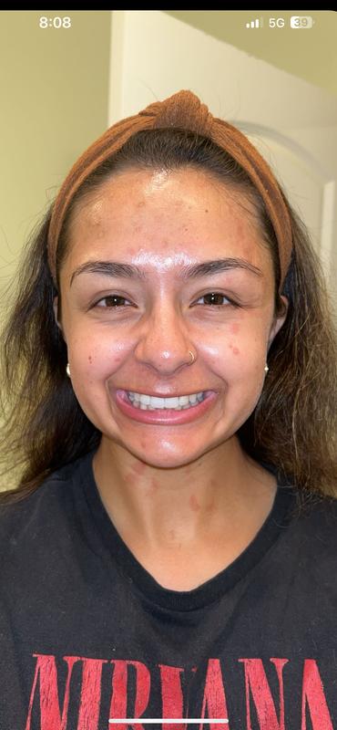 Post poison oak, acne scars, sun spots