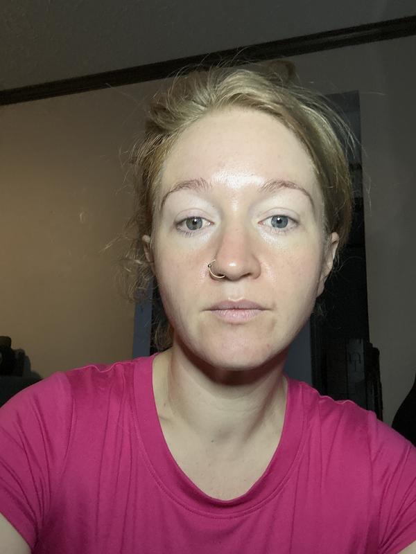 No pimples skin has improved (now to work on the old scaring)