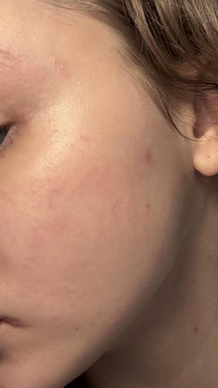 Eczema zones reacting to perfume, post-5 min cool down period.