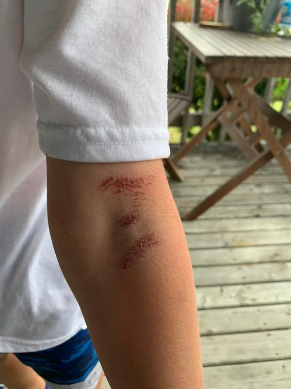 This was after wearing the wetsuit twice. He would rather deal with being a little bit cold over pain. These pictures were taken two days after he wore the suit. He still has the marks and it has been five days - he won’t be wearing this again.
