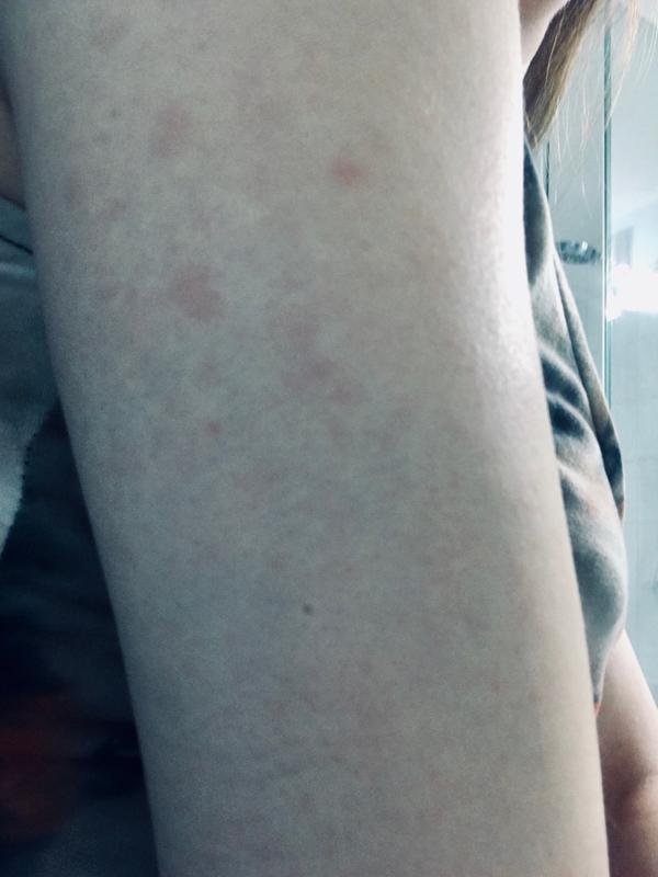 Occur skin rash