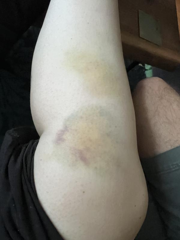 The bruise I got when I fell off.