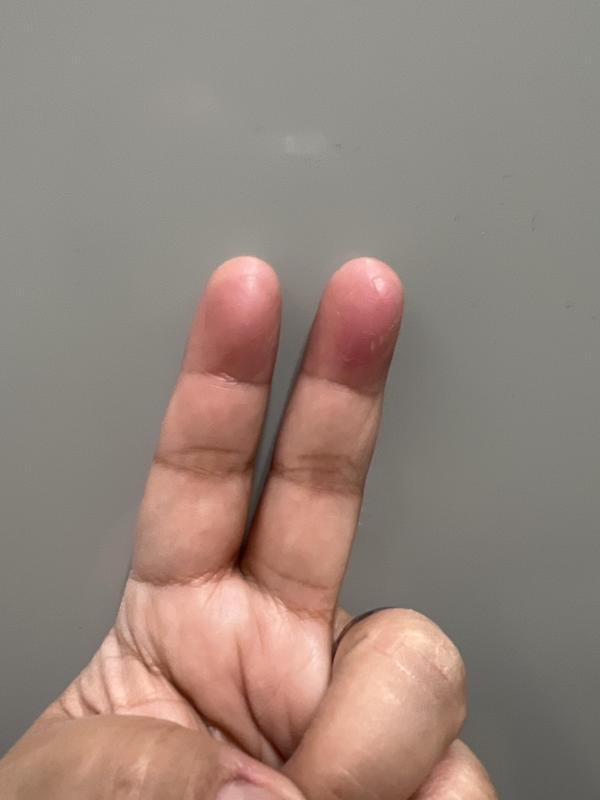 Only 2 fingers same with other hand that get blisters.