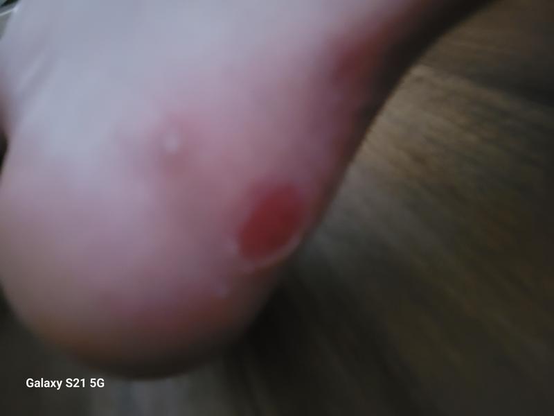 This is the result. Very disappointed carhartt.