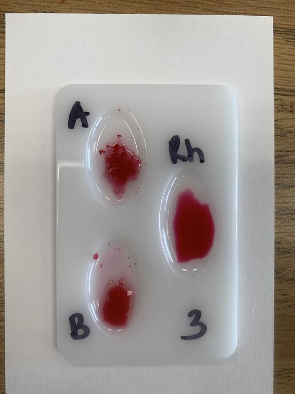 Innovating Science Genetics of Blood Types Using Simulated Blood Kit:Education