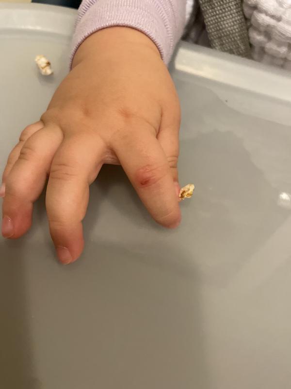 Skin torn from sharp plastic.