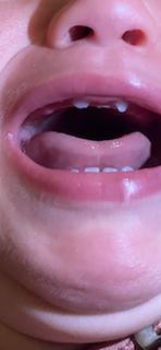 My daughter's chipped teeth due to this horrible product.