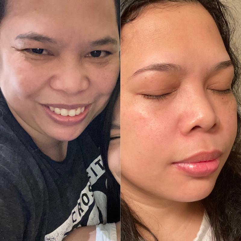 Before And After Retinol Serum corona.dothome.co.kr