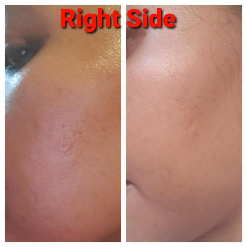 Resurfacing Retinol Serum, Post-Acne Marks Treatment