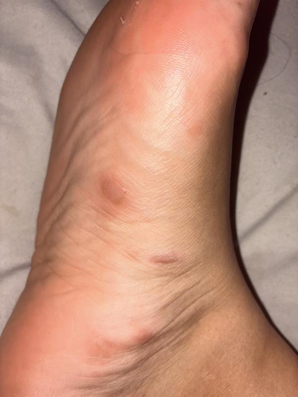 Customer photo for "Blisters everywhere"