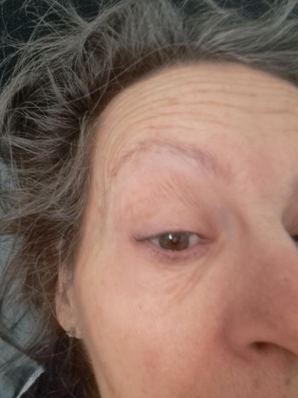 Swollen, red eye