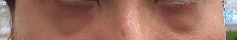 Current under eye condition