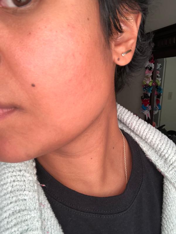 A rash from the serum.