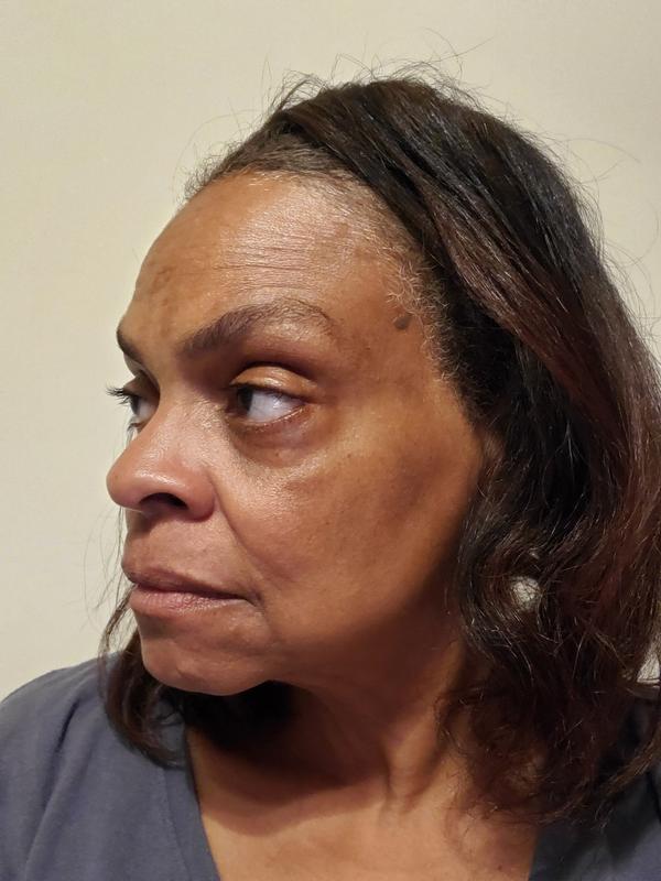 Still have dark circles