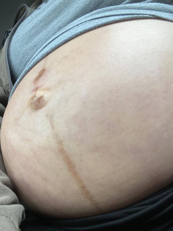 There was stretch marks there. This oil is putting in work.