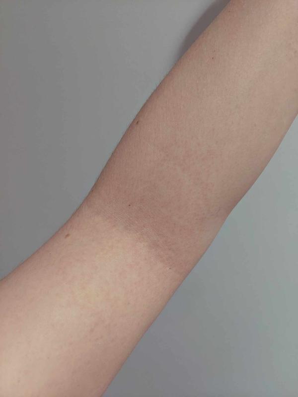 patch test on inner arm caused allergic contact dermatitis