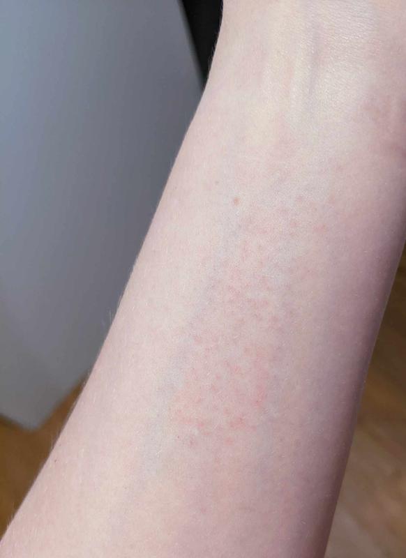 Contact dermatisis 2 days post patch test - reaction occured within 24h