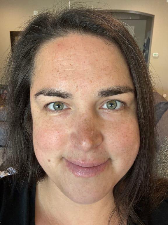 My face before using the pads and toner.