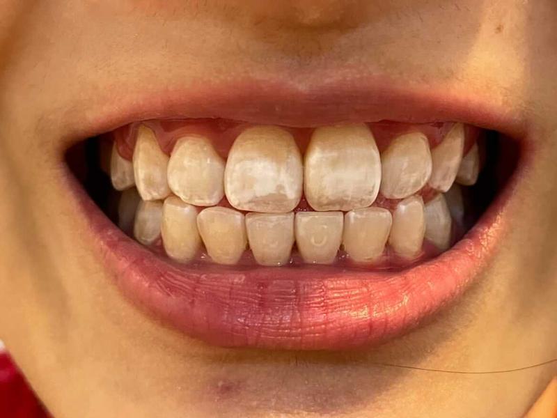 crest teeth whitening strips before and after