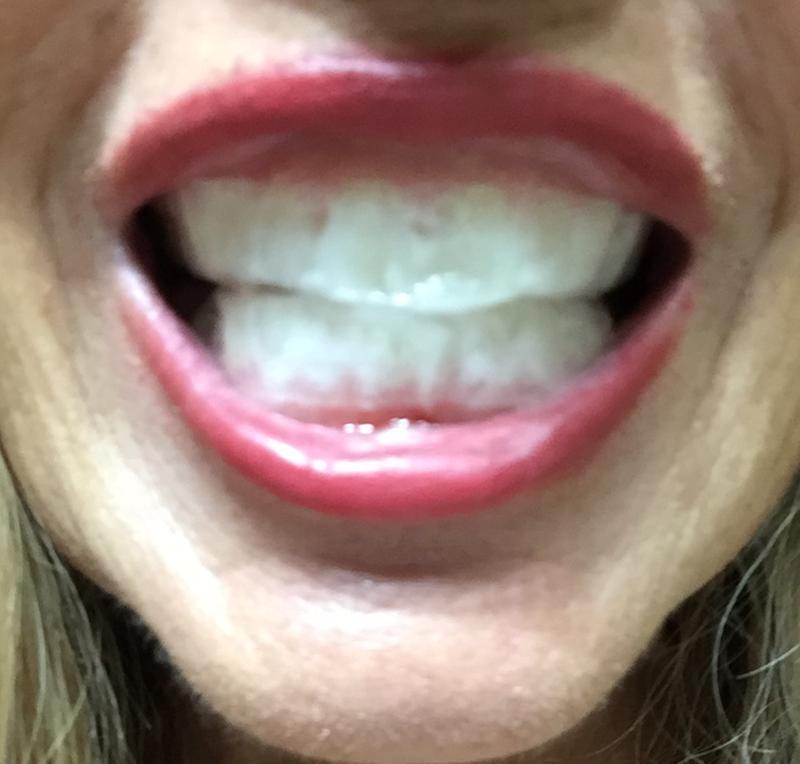 crest teeth whitening strips before and after