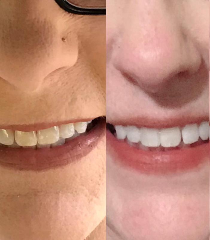 crest teeth whitening strips before and after