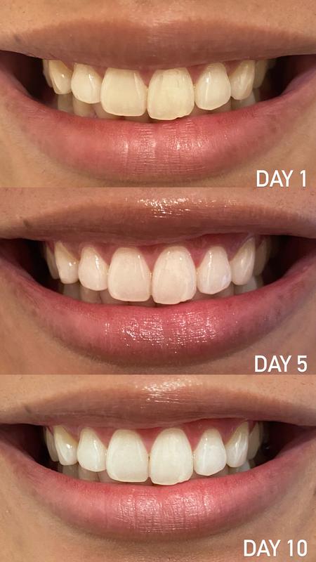 crest teeth whitening strips before and after