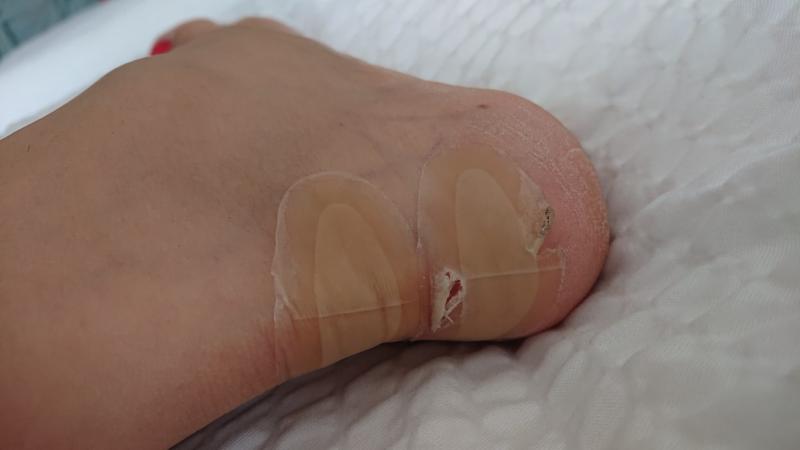 Perforated hydro seal