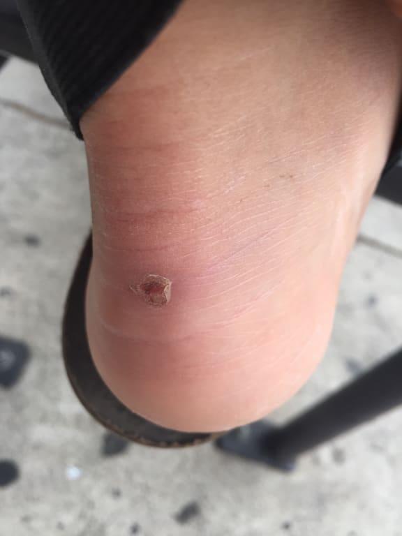 Blister scar, still healing