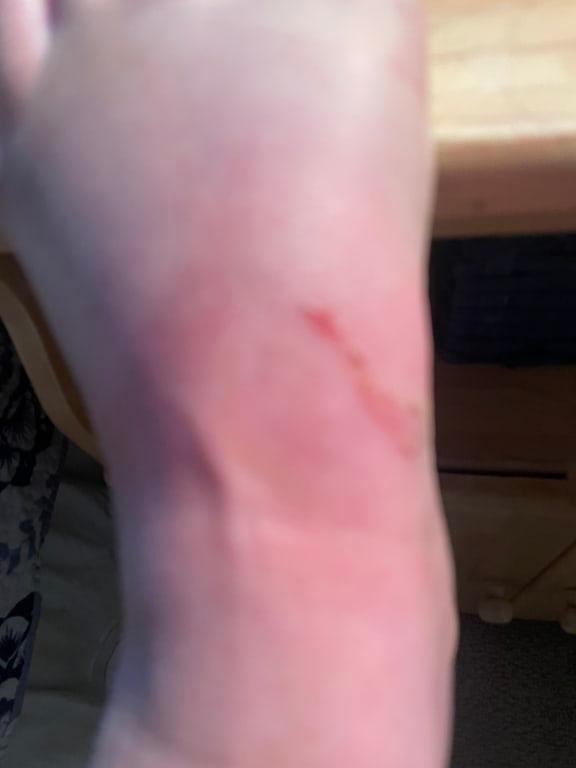 Day after wearing sandals