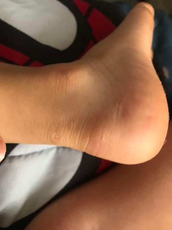 They're all healed now. But as you can tell he had blisters.