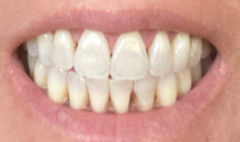 Tray 1 vs tray 10, somewhat disappointed : r/Invisalign