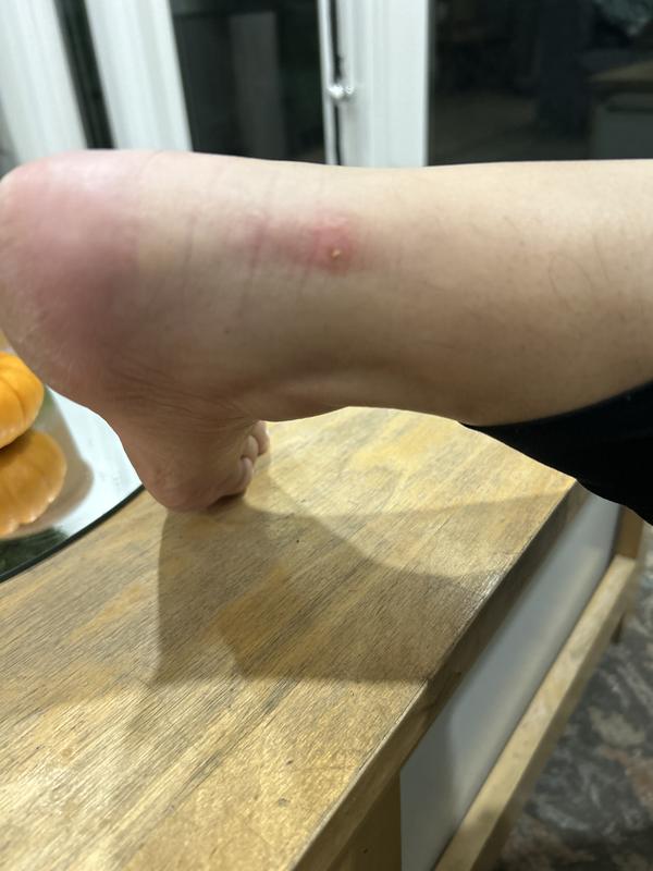 Rubbed my skin raw and cut me