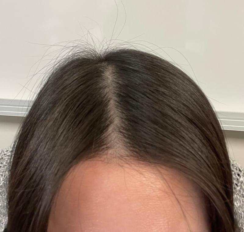 Customer photo for "It makes my scalp oily and the hair just stick to the scalp"