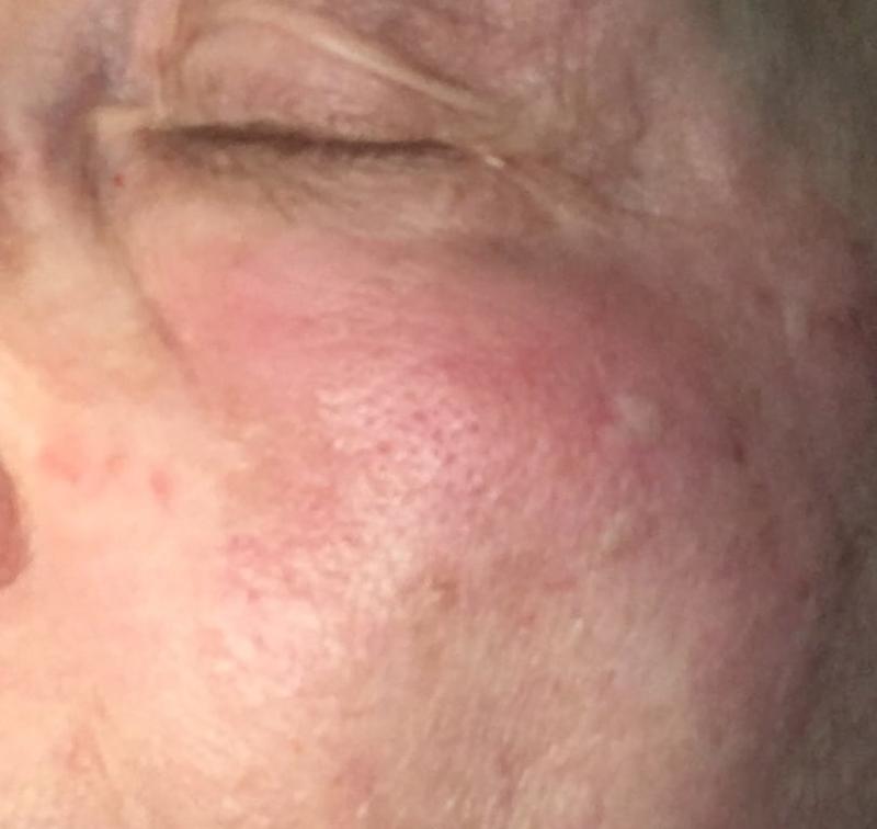 Customer photo for "Woke up with hives"