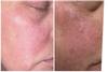 Right is reactivity from Trent & the humidity. Left side is morning after using cicaflate serum and moisturizer