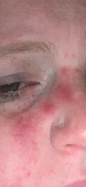 I had no acne before this crème at all!