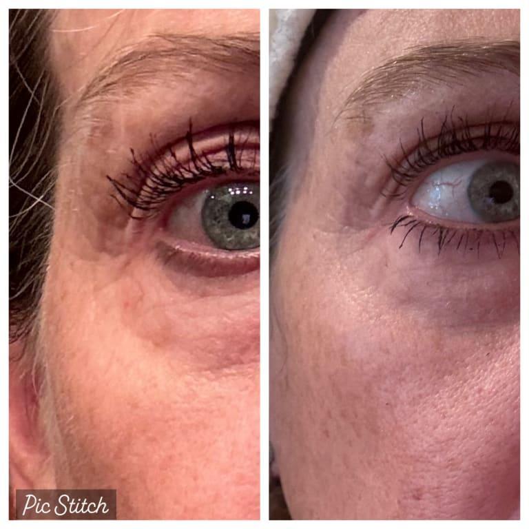 Instant results around the eyes! Before and after.