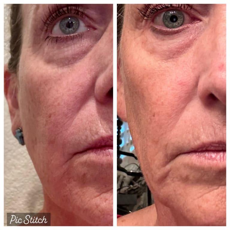 Before and after, noticeably softer fine lines and wrinkles around mouth and eyes.
