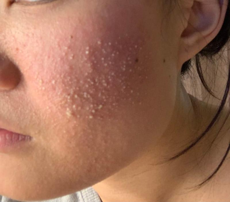 A few days after using it, rashes & blister started appera on my checks. Whole face swelling, itchy, and red