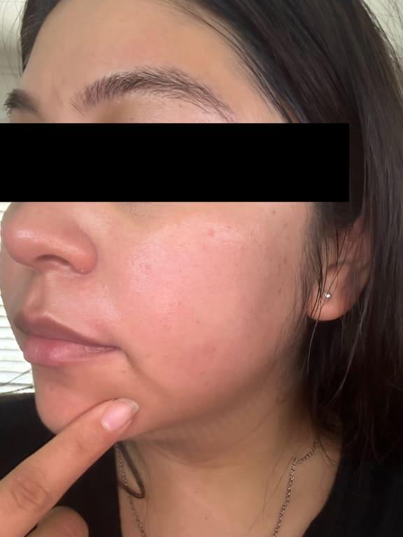 Decreased redness and no irritation