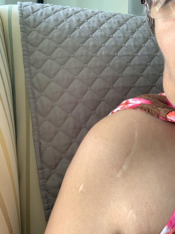 My scar which gets daily doses of bio oil 💘