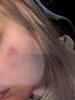 My burns after burn cremes applied, 14 hours after last patch removal