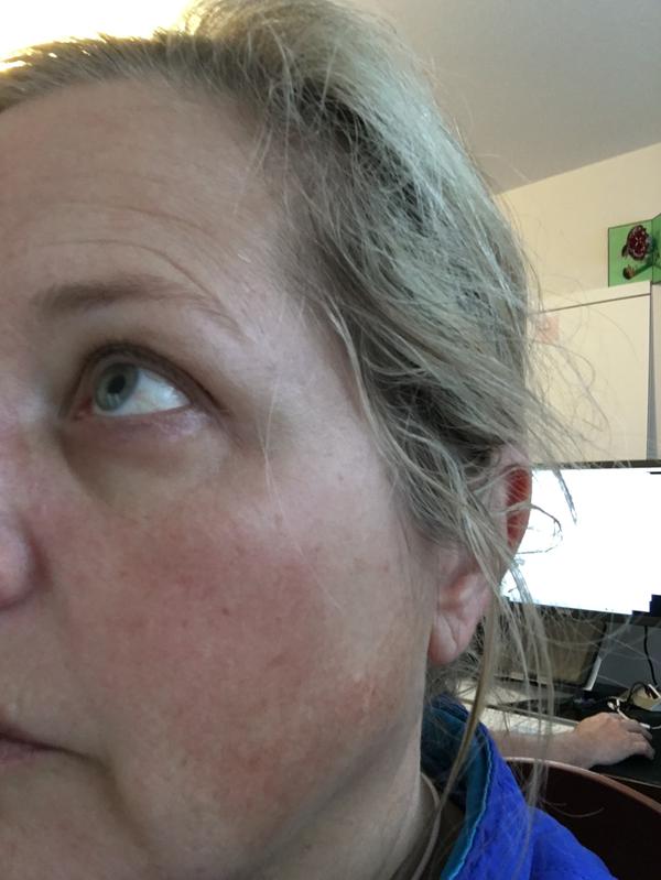 My 50-year old skin after using Micellular Water. No serum or creme yet. No make up.