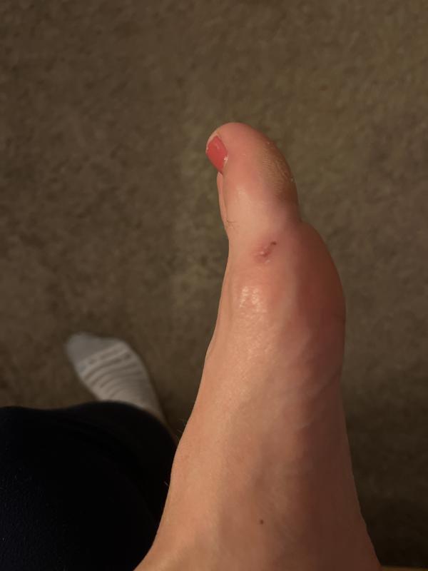 Blister 1