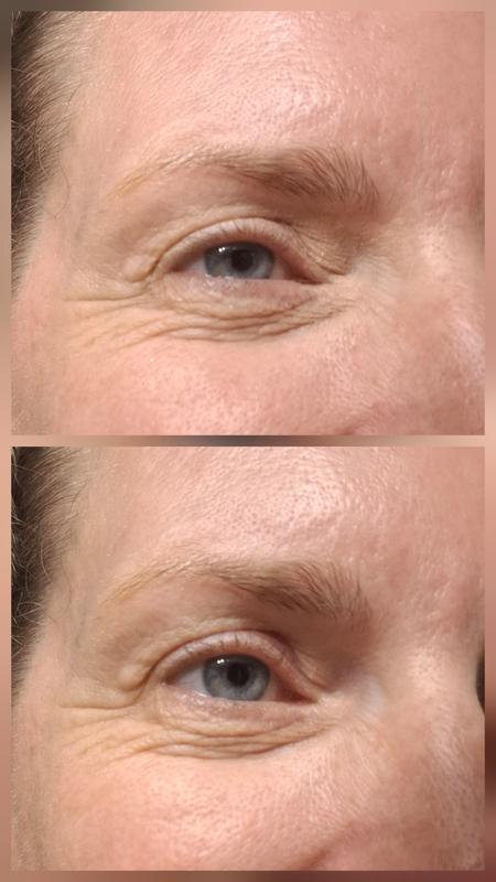Botyom: Before, Top: After