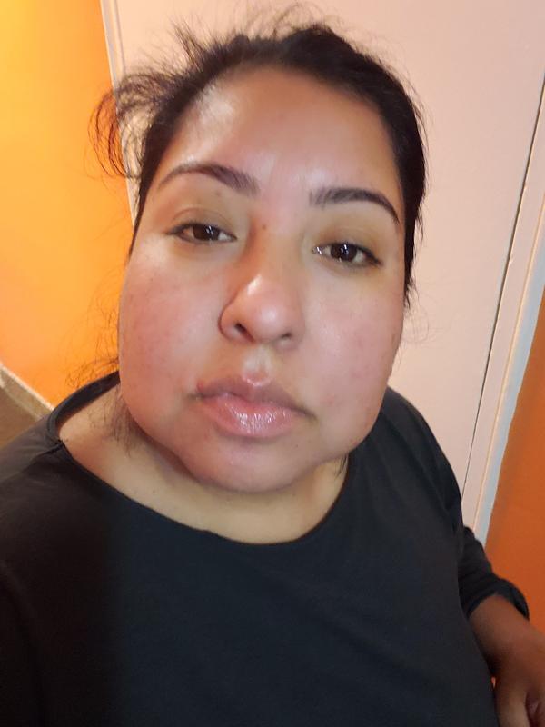 I been suffering acne skin thise past years